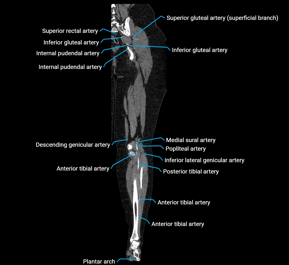 CTA lower limb coronal cross sectional anatomy labelled image _61 (2).webp